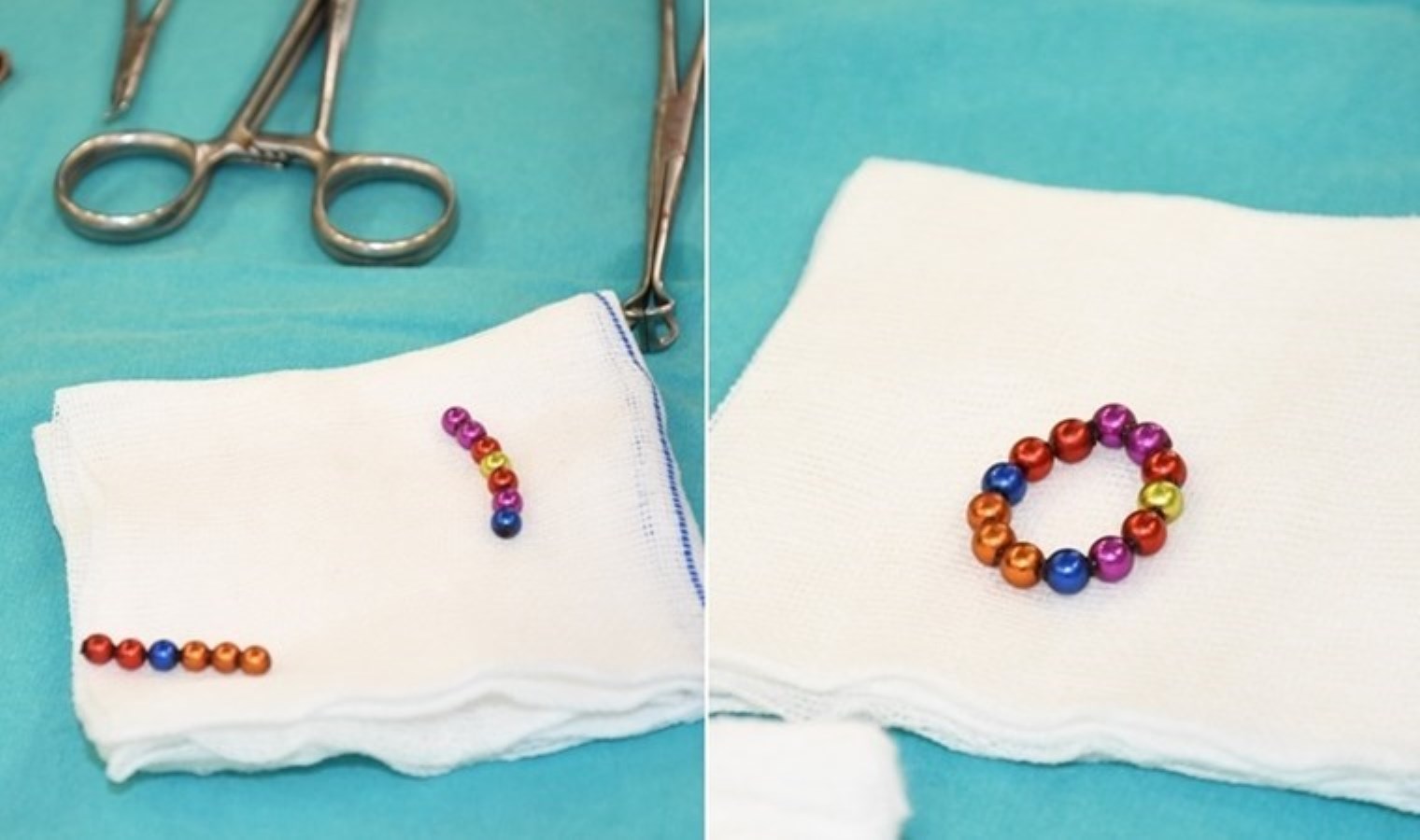 Yozgat’ta şaşırtan olay… 4 yaşındaki çocuğun bağırsağından 13 mıknatıslı boncuk çıkartıldı!