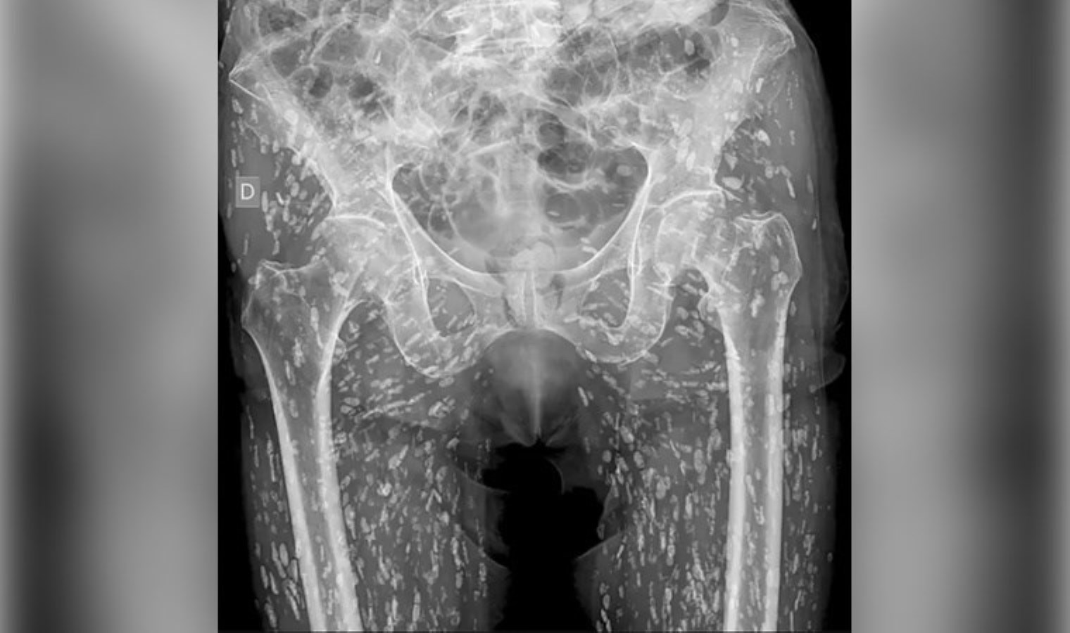 Röntgen, adamın vücudunda parazitlerin ürediğini ortaya çıkardı
