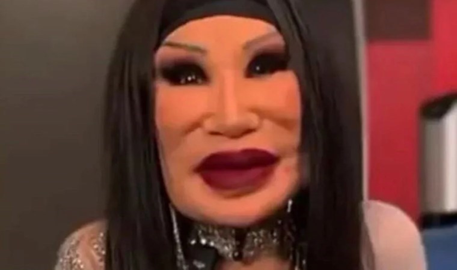 Ünlü oyuncu tanınmaz halde! Son hali korkuttu: Yüzüne ‘yemeklik yağ’ enjekte ettirdi