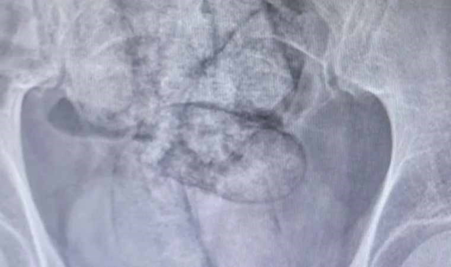 Artvin’de İran uyruklu şüphelinin bağırsaklarından 350 gram uyuşturucu çıktı