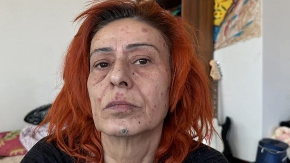 Boya yüzünden yüzü yanmıştı! Yıldız Tilbe’den yeni açıklama geldi