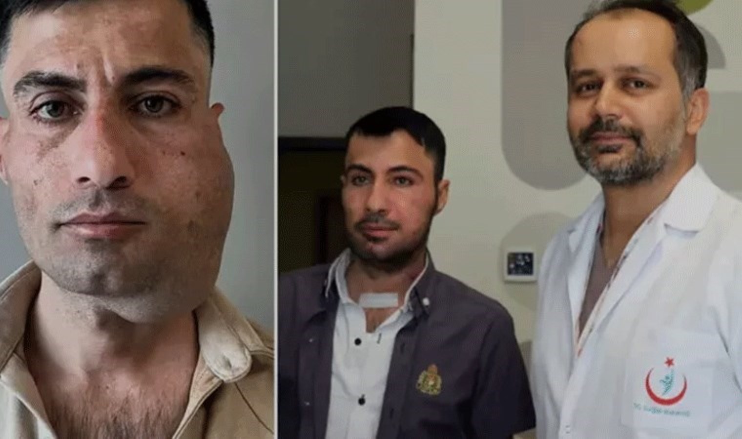 Çenesinden dev tümör çıkarıldı: Bacağından yeni çene yapıldı!