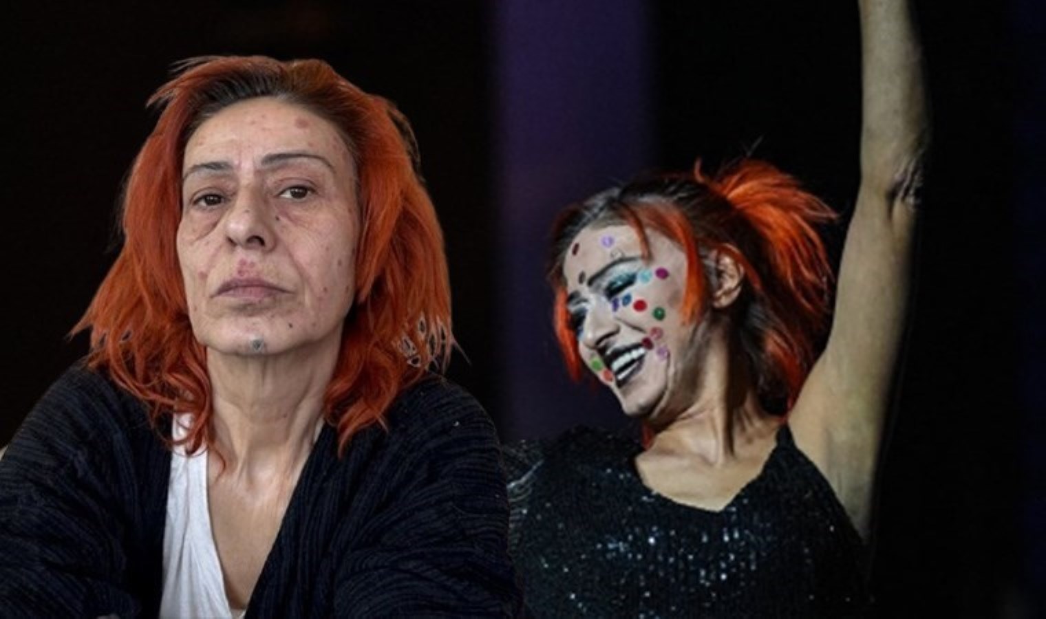 Daha önce maske takmıştı: Yüzü yanan Yıldız Tilbe şimdi de renkli beneklerle sahneye çıktı!