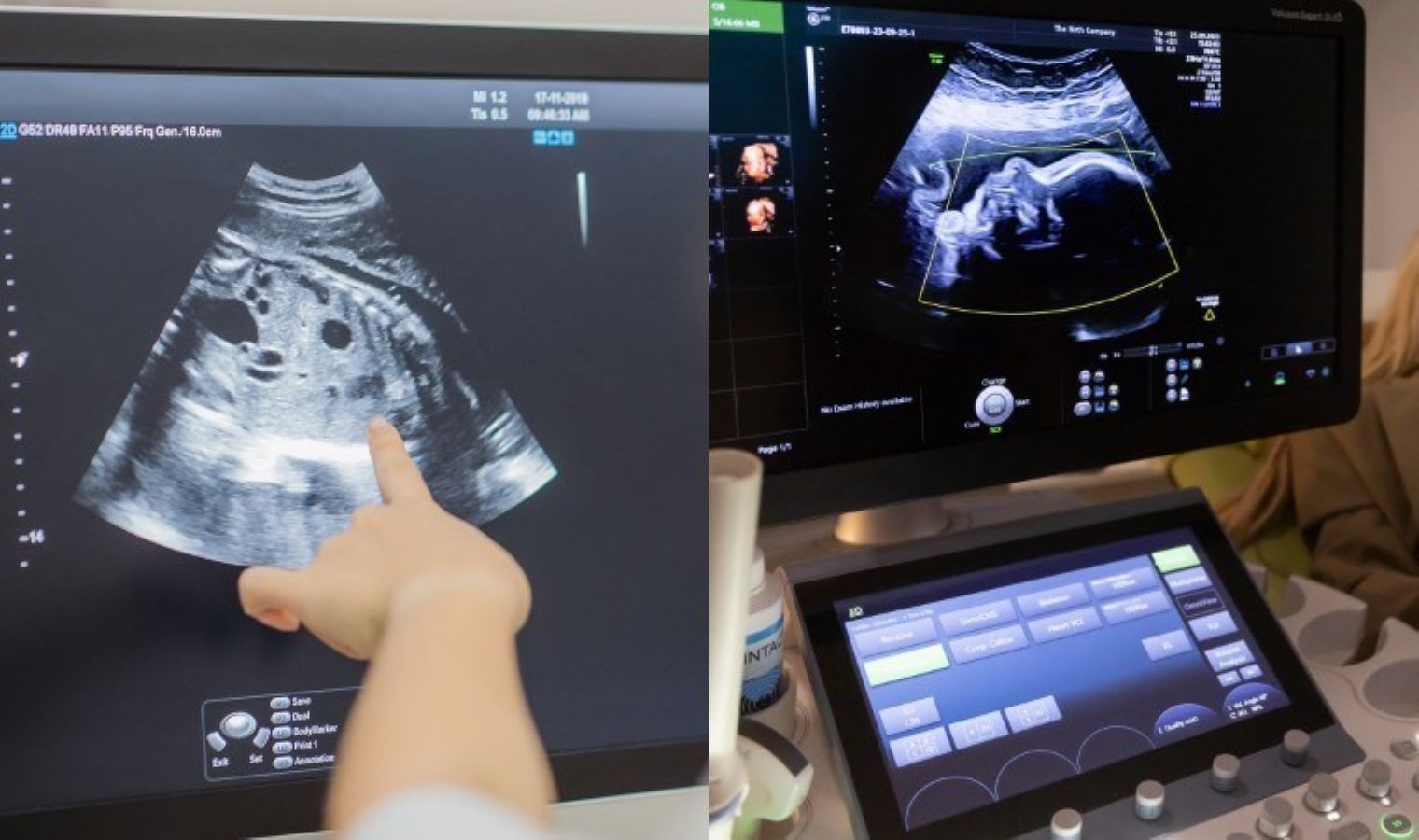 Dünyanın en nadir vakası: Bebek kendi ikizlerini karnında taşıyarak doğdu