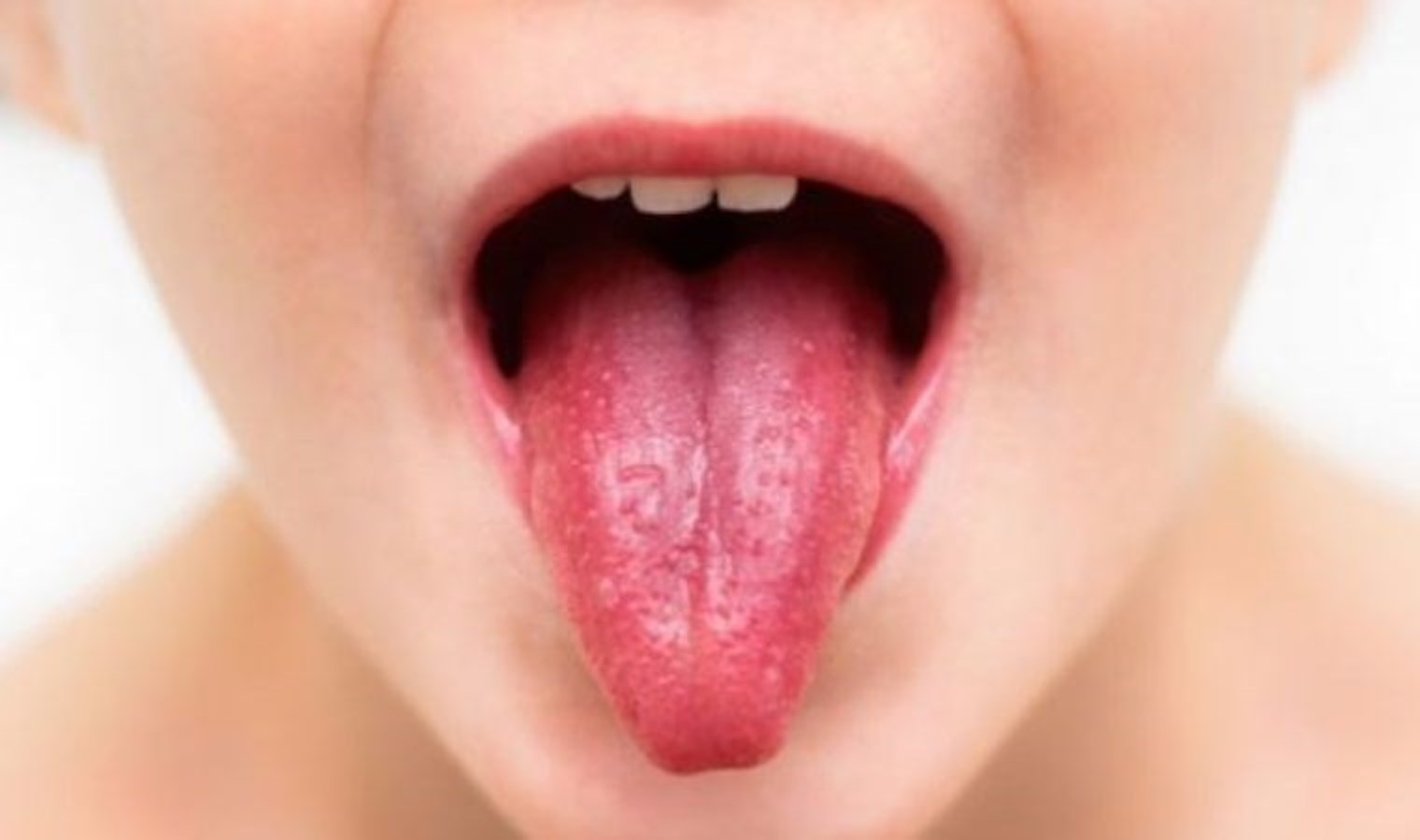 Kawasaki hastalığı nedir? Kawasaki hastalığı ne demek?