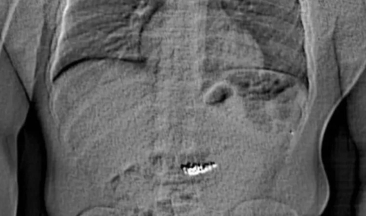 Polisi görünce küpeleri yuttu! Değeri tam 770 bin dolar…