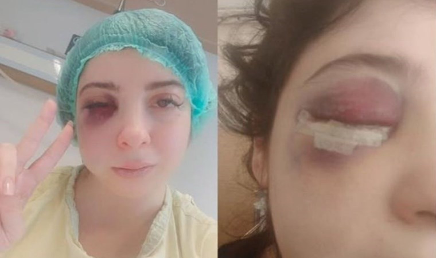 Sokak ortasında tacize uğrayıp darbedilen Damla: Artık yüzümün sol tarafını hissetmiyorum