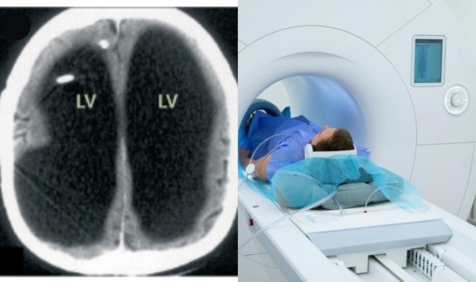 Tıp dünyasını şaşkına çeviren vaka: Beyninin eksik olduğu ortaya çıktı