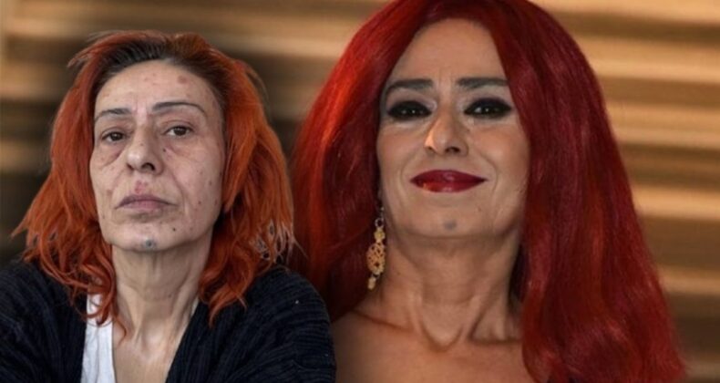 Yıldız Tilbe yüzünün nasıl yandığını anlattı: ‘Uyudu’ iddialarına yanıt verdi!