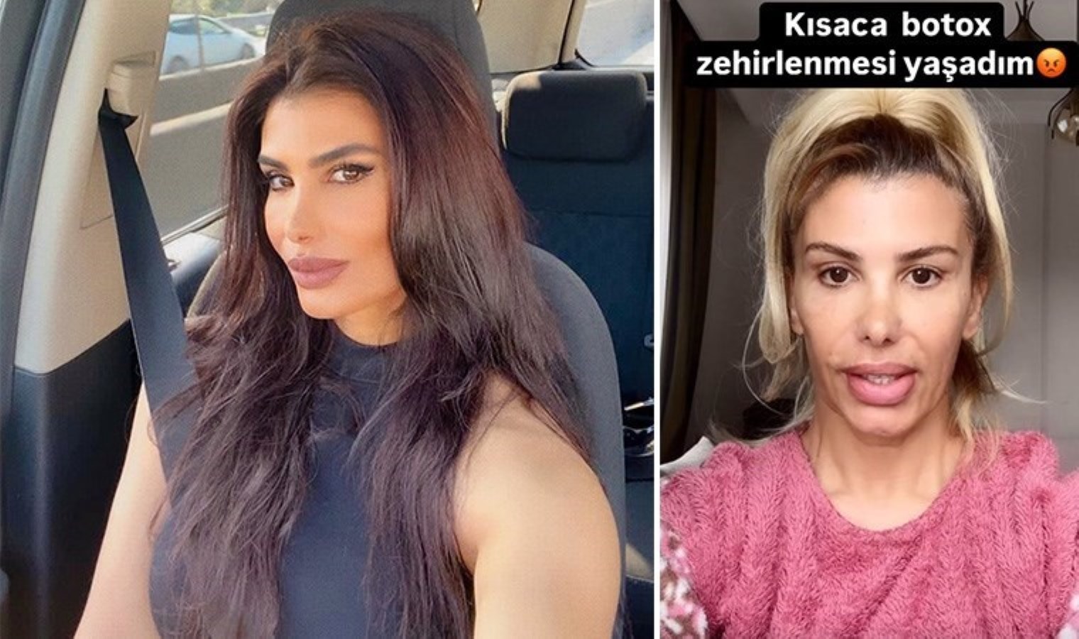 Botokstan zehirlendi! Türkücü Hatice: ‘Yanlış botoks mağduru oldum’