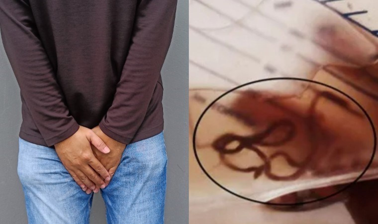 Gaz sancısı sandı, hastaneye başvurdu: Mesanesinden dev parazit çıktı