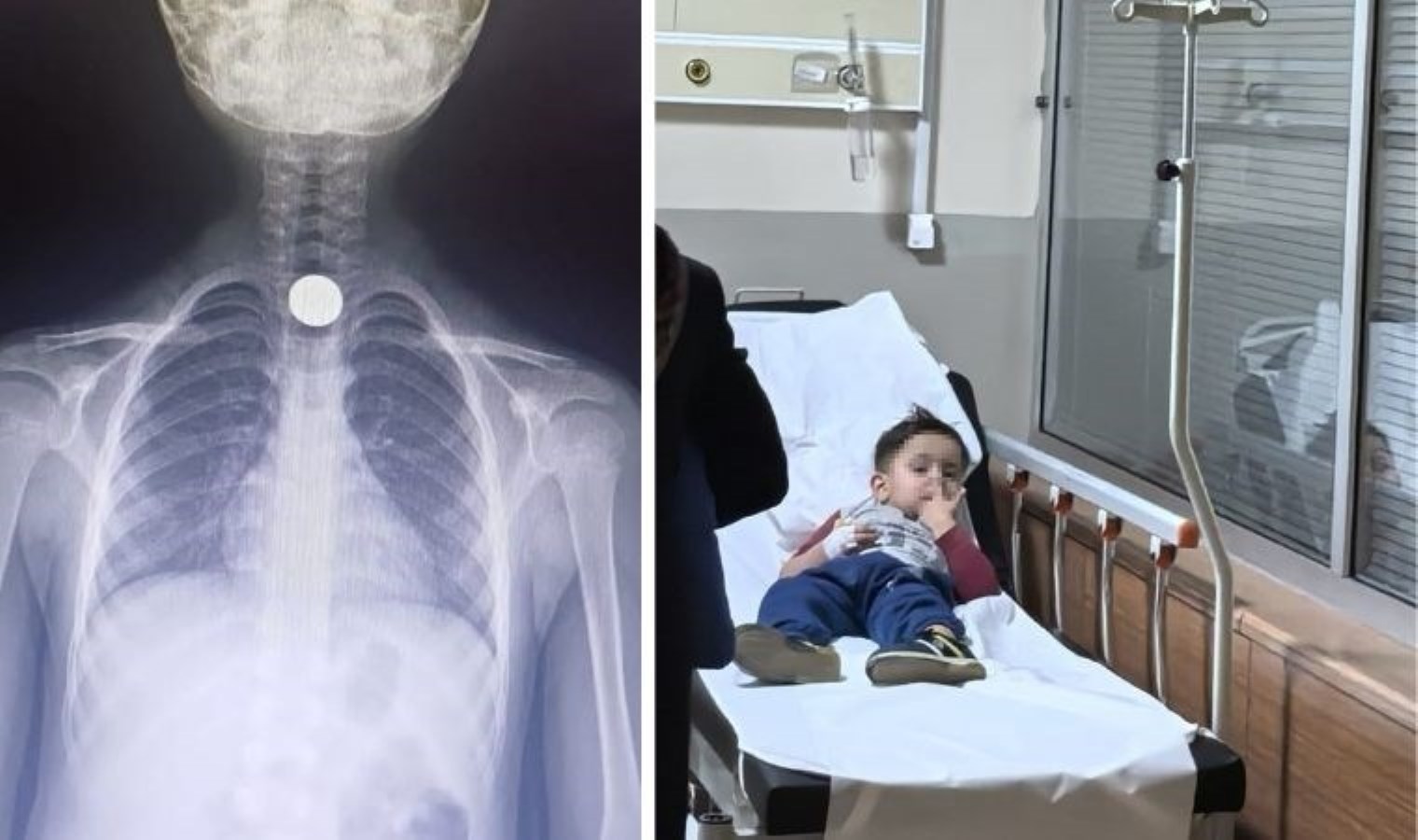 Yusuf’un yemek borusuna takılan madeni para operasyonla çıkartıldı