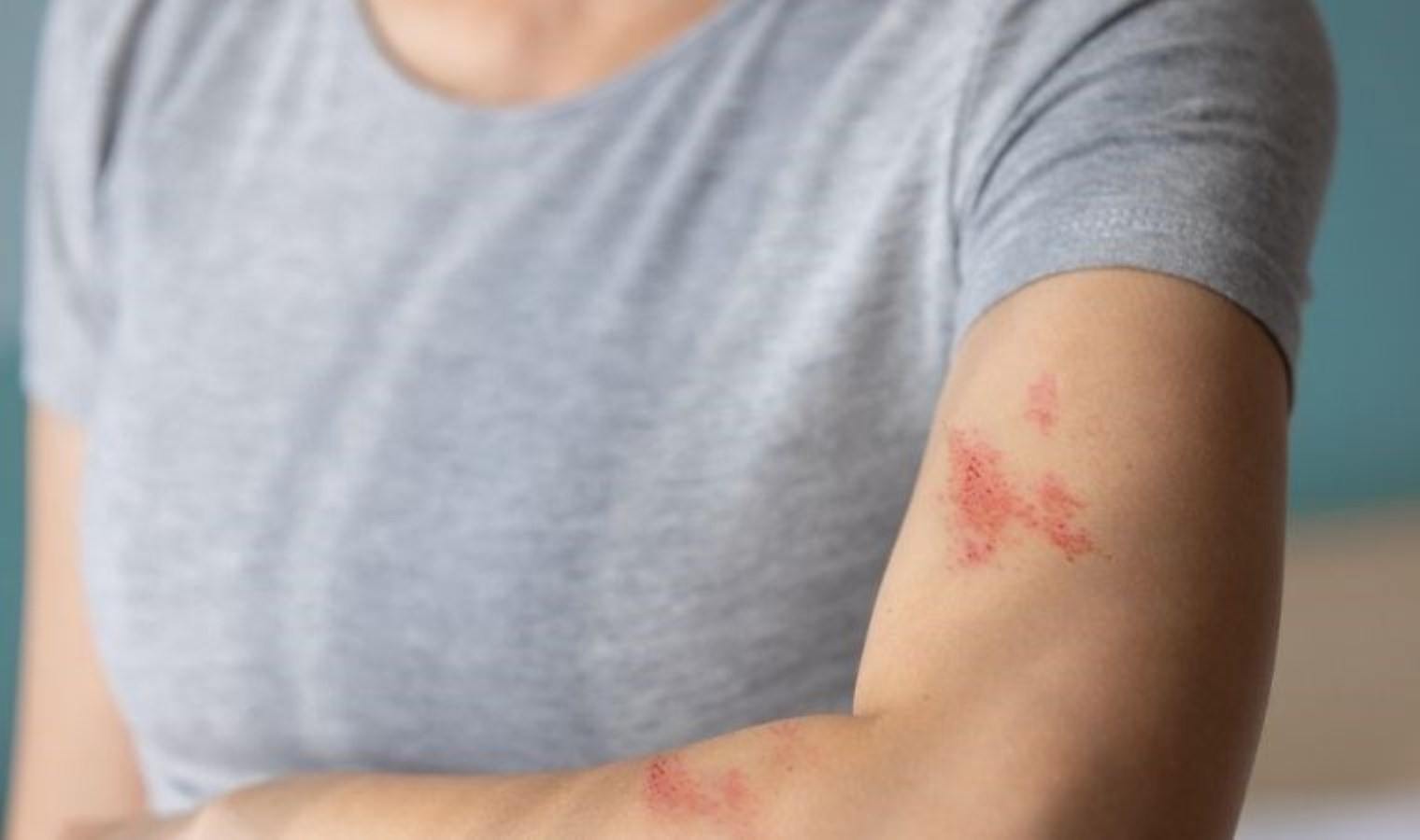 Zona nedir? Zona hastalığı belirtileri neler? Zona tedavi edilir mi?