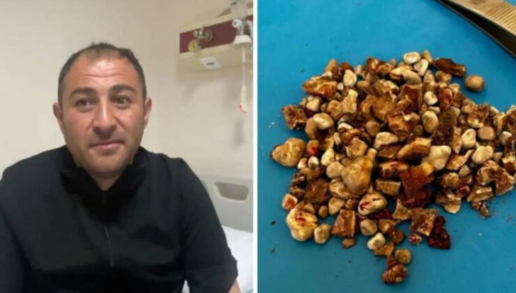 Böbreklerinden 300’ü aşkın taş çıktı: ‘Hatırası var’ deyip evine götürdü