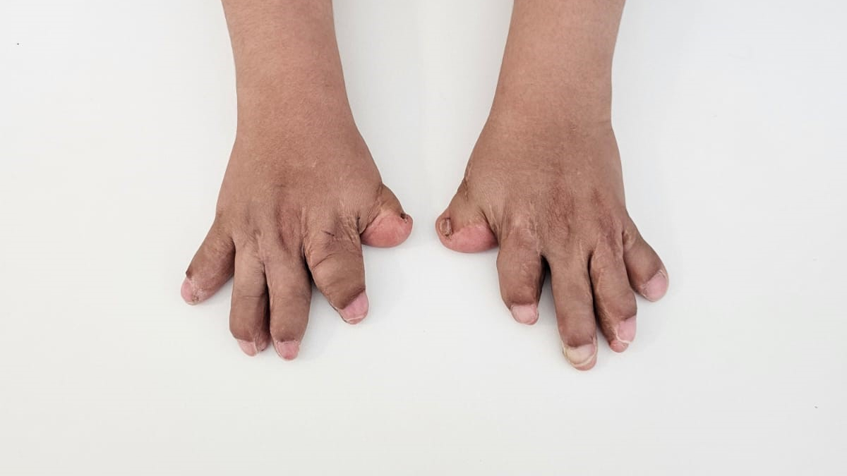 Doktorların ismini yeni duyduğu rahatsızlıkla doğan Umut’un 10 parmağı ameliyatla açıldı