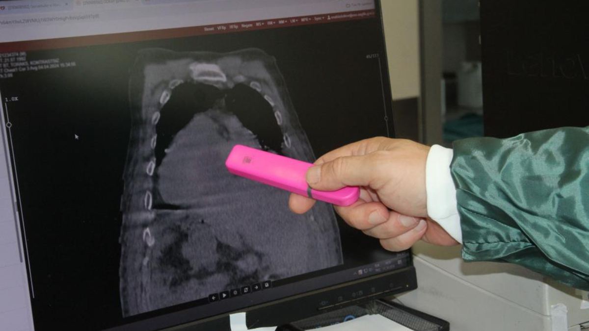 Giresun’dan tıp dünyasına katkı: Karadeniz Sendromu