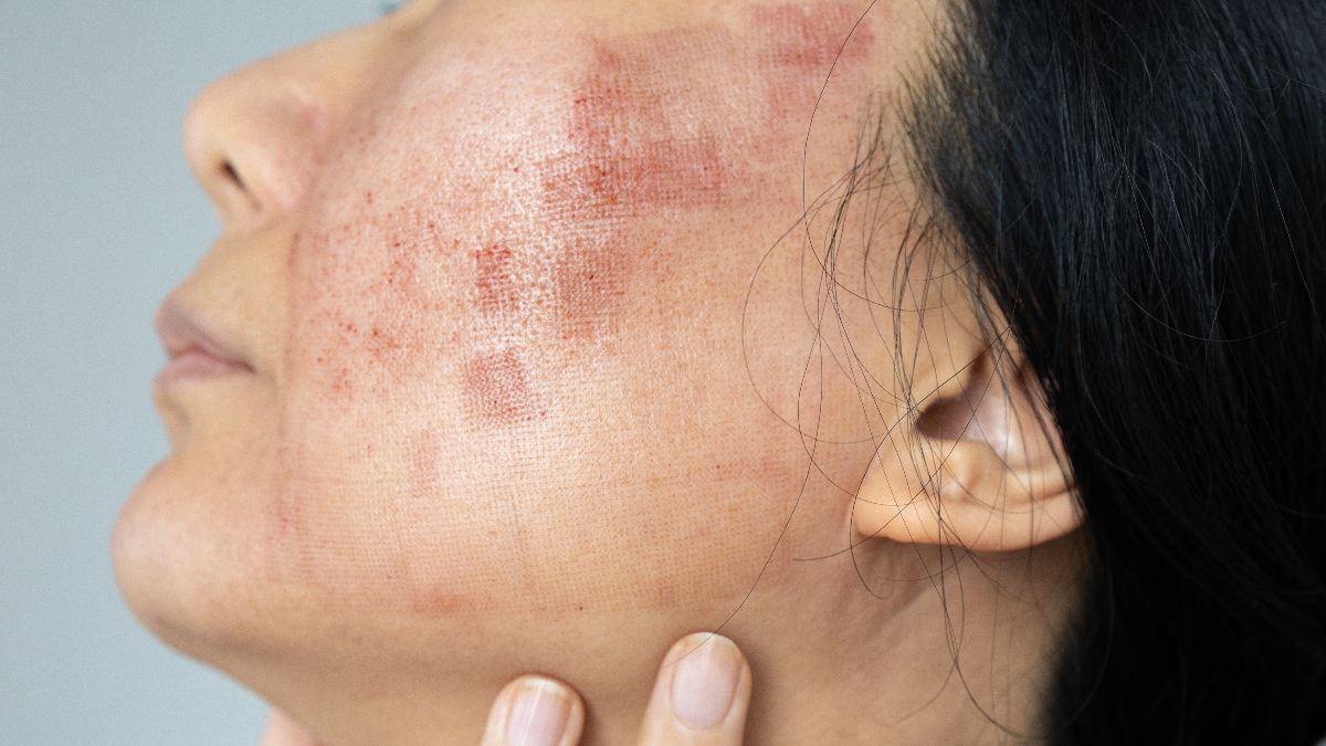 Lupus hastalığı hakkında bilmeniz gerekenler