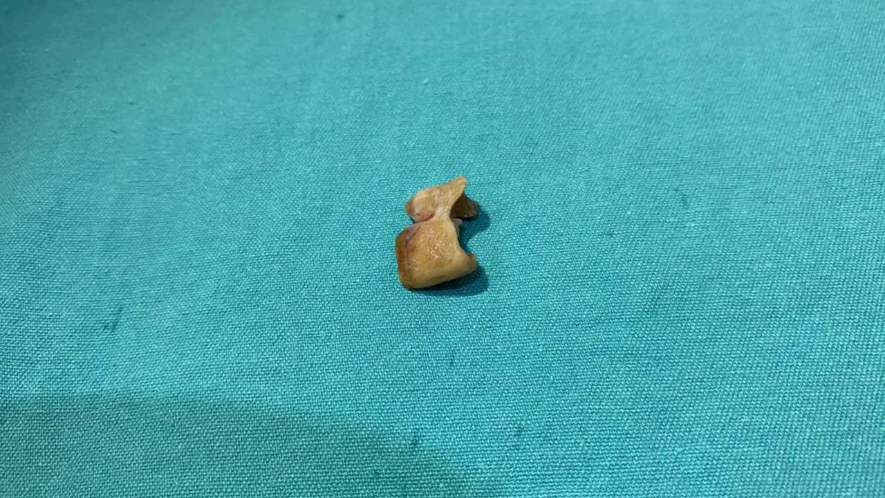 Uykusunda dişlerini yuttu, bronşundan çıktı!