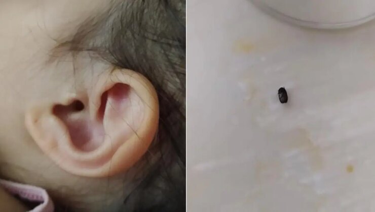 3 yaşındaki çocuğun kulağına kene yapıştı!