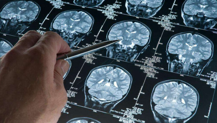 Alzheimer riskini artıran genetik varyant bulundu