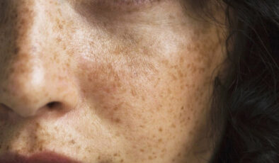 Güneş lekelerine İbn-i Sina yöntemi: Silgi gibi siliyor…