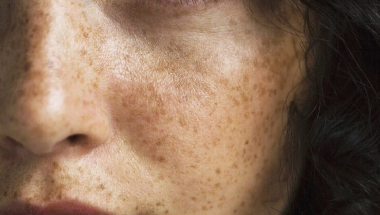 Güneş lekelerine İbn-i Sina yöntemi: Silgi gibi siliyor…