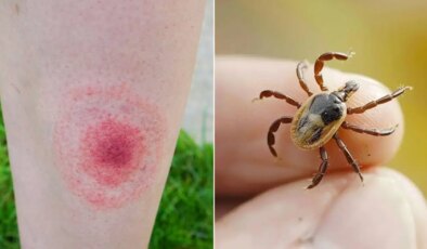Keneler lyme hastalığına sebep oluyor! Uzman az, fark edilmeden ilerliyor…