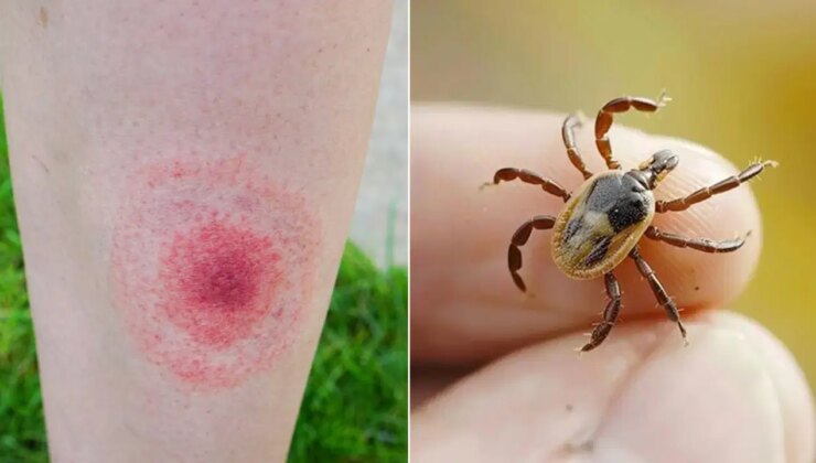 Keneler lyme hastalığına sebep oluyor! Uzman az, fark edilmeden ilerliyor…
