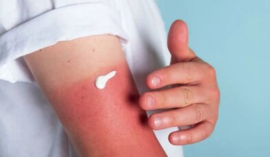 Lekelere ve yanıklara karşı doğanın gücünü kullanın: Güneş yanıklarına iyi gelen 7 doğal yöntem