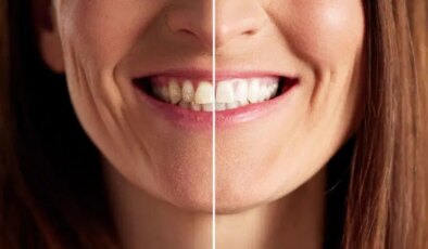 Parlak ve sağlıklı bir gülüşün sırrı mutfağınızda saklı: Diş beyazlatmada oldukça etkili 7 doğal yöntem