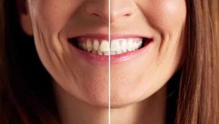 Parlak ve sağlıklı bir gülüşün sırrı mutfağınızda saklı: Diş beyazlatmada oldukça etkili 7 doğal yöntem