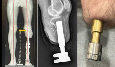 Protez kullananlara umut olan osseointegrasyon yöntemi