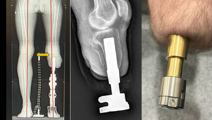 Protez kullananlara umut olan osseointegrasyon yöntemi
