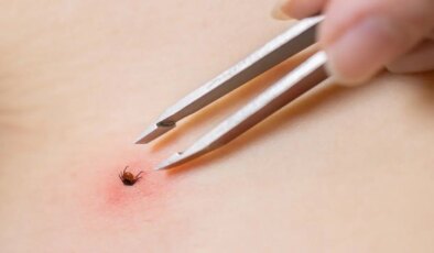 Yaz aylarının kabusu geri döndü:  Keneden korunmanın basit ama etkili yolları neler?