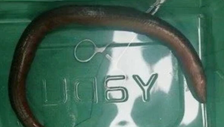 Çin’de hasta adamın karnından canlı yılan balığı çıktı