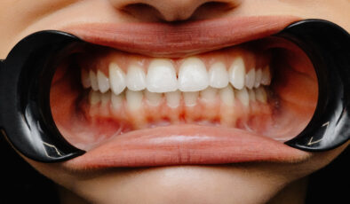 Diş etlerindeki renk değişiklikleri hastalıkların habercisi olabilir