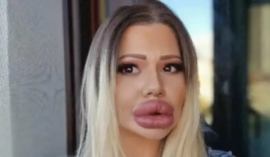 ‘Dünyanın en büyük dudaklarına’ sahip kadın estetik öncesi nasıl görünüyordu?