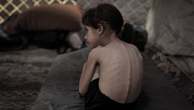 Gazze’de çocuklar açlık ve hastalıkla mücadele ediyor