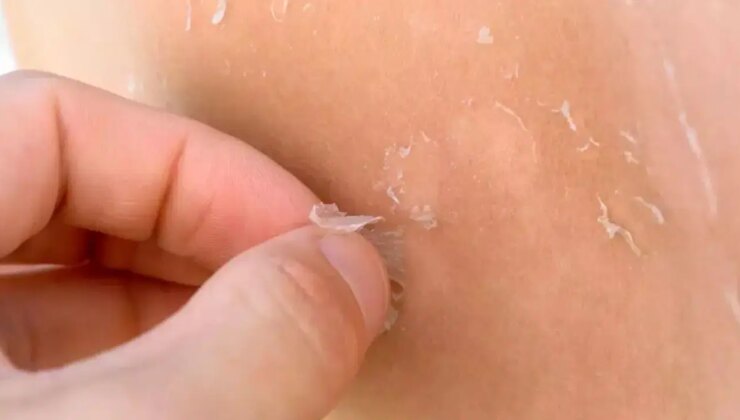 Güneş yanığı sonrası cilt soyulmasını hafifletmenin yolları