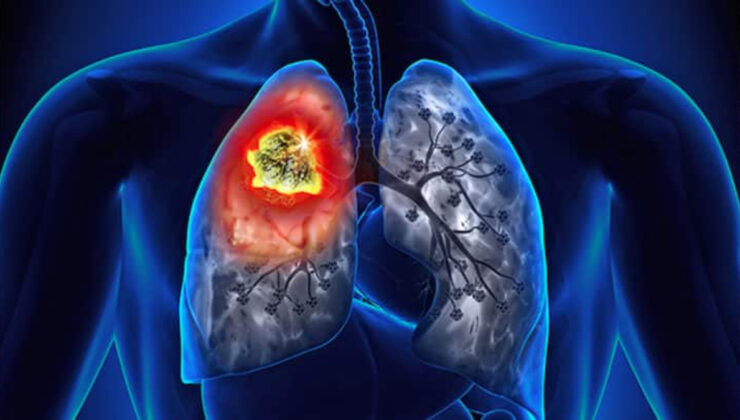 Hava kirliliği sigara içmeyenlerde akciğer kanserine yol açıyor