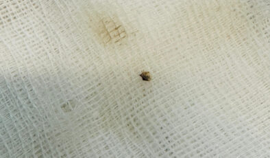 Kahramanmaraş’ta halsizlik nedeniyle hastaneye gitti: Karnına yapışan kene bulundu