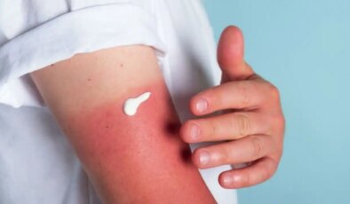 Kızarıklık ve yanma hissinin panzehiri doğada gizli: Güneş yanıklarına iyi gelen 8 doğal çözüm