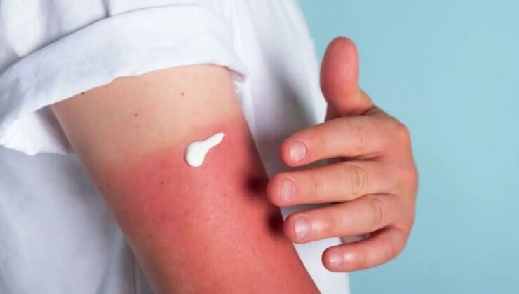 Kızarıklık ve yanma hissinin panzehiri doğada gizli: Güneş yanıklarına iyi gelen 8 doğal çözüm