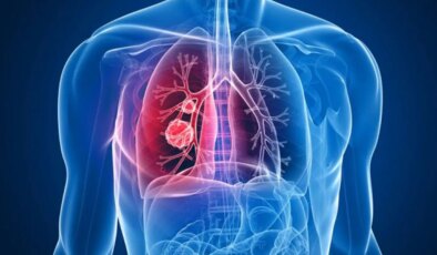 ’Sigarasız akciğer kanseri’ vakalarında dikkat çeken artış