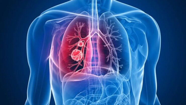 ’Sigarasız akciğer kanseri’ vakalarında dikkat çeken artış