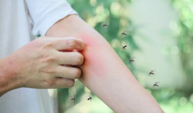 Sivrisinek ısırığına karşı doğal çözümler: Kaşıntıyı ve tahrişi hafifletmenin yolları