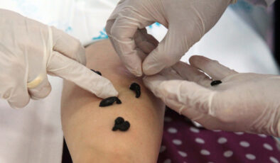 Sülük tedavisi caiz midir? Diyanet yanıtladı: Sülükle tedavinin hükmü…