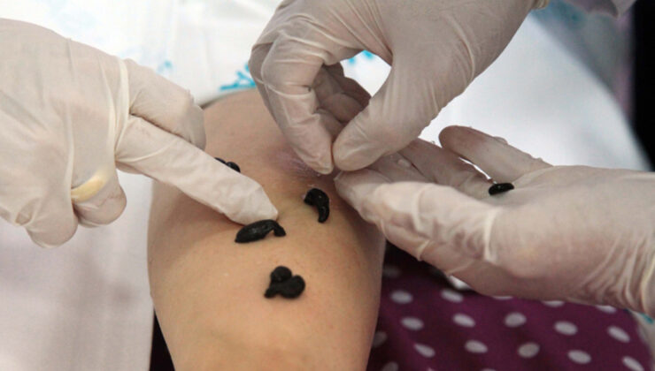 Sülük tedavisi caiz midir? Diyanet yanıtladı: Sülükle tedavinin hükmü…