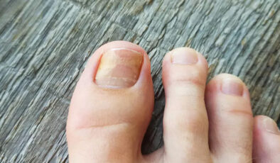 Tırnak mantarına doğal çözüm: 2 malzeme yetiyor, mantardan eser kalmıyor