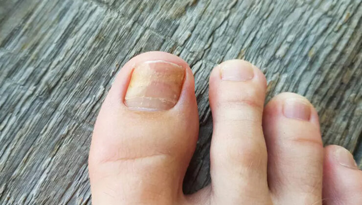 Tırnak mantarına doğal çözüm: 2 malzeme yetiyor, mantardan eser kalmıyor